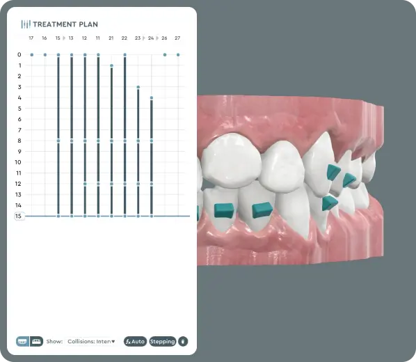Intelligent Optimization—Refine Plans for Greater Comfort and Predictable Results Development of efficient treatment plans